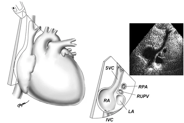 Pediatric Echocardiography