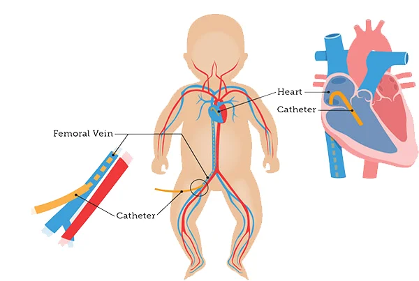 Pediatric Cardiac Angiography